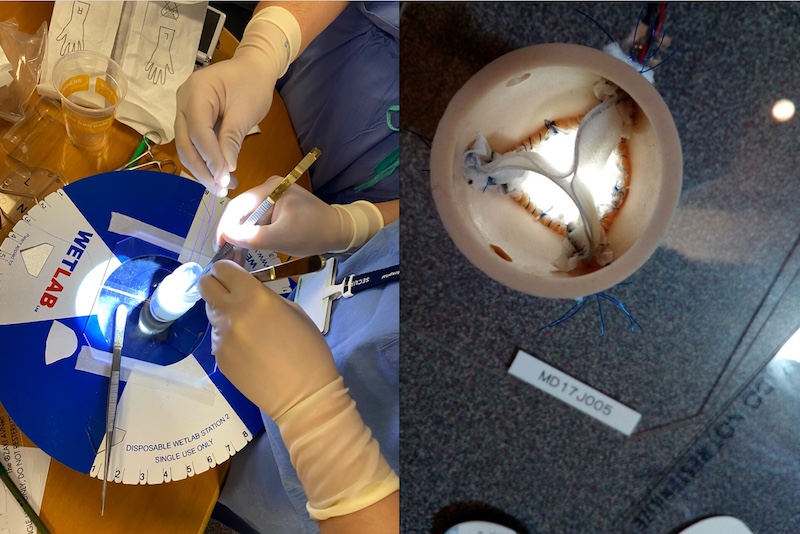 Bringing the Ozaki procedure to children worldwide - Boston Children's Answers