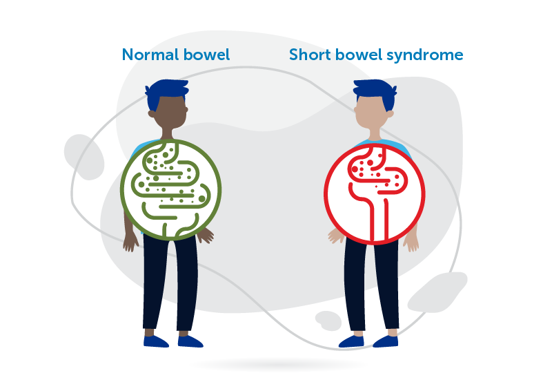 Illustration of short bowel syndrome compared to healthy bowell