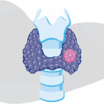 an illustration of a thyroid gland with a thyroid nodule