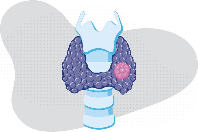 an illustration of a thyroid gland with a thyroid nodule