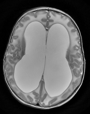 MRI brain image showing marked hydrocephalus