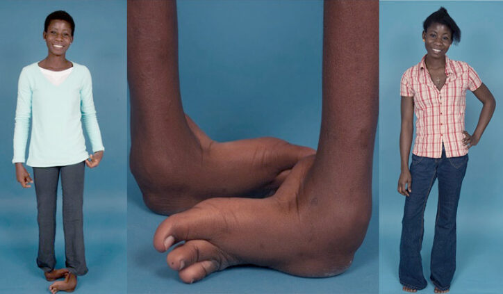 Theresah's feet before and after her clubfoot treatment. 