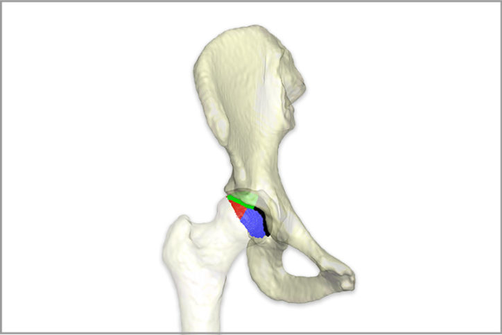 A 3D image of a hip joint with color-coding indicating the degree of hip dysplasia.