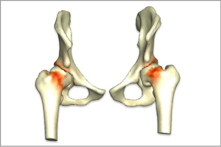 A simulated image of hip impingement.