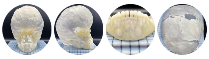 Three-dimensional recreations of a young girl's skull that include incomplete closure of skull bones due to an encephalocele.