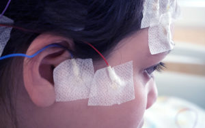 The head of a little girl with EEG leads attached to her face and scalp.