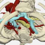 A 3D image shows the view of a patient's chest wall from above.