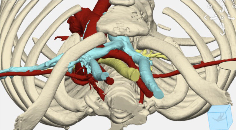A 3D image shows the view of a patient's chest wall from above.