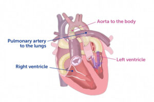 An illustration shows the anatomy of a heart after a reverse double-switch procedure.