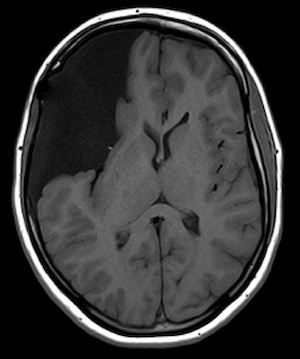 radiographic image of an arachnoid cyst in the brain.