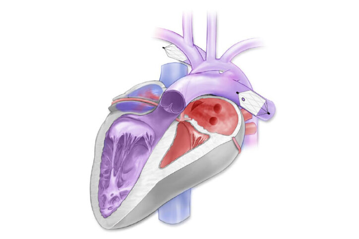 An illustration shows a PA flow restrictor in two separate pulmonary arteries.