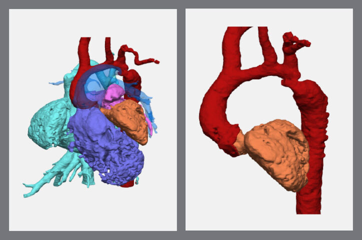 Side-by-side images of a 3D model show two perspectives of a patient's heart and an aortic arch condition.