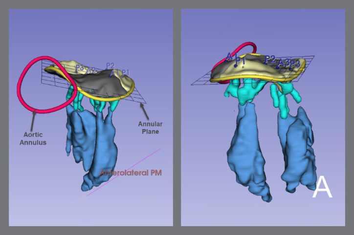 Side-by-side images of a 3D model focus on a patient's mitral valve.
