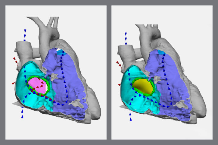 Side-by-side images of a 3D model show, on left, a hole in a heart, and, on the right, the heart with a repair patch.


