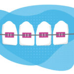 An illustration shows red braces running across four top teeth.