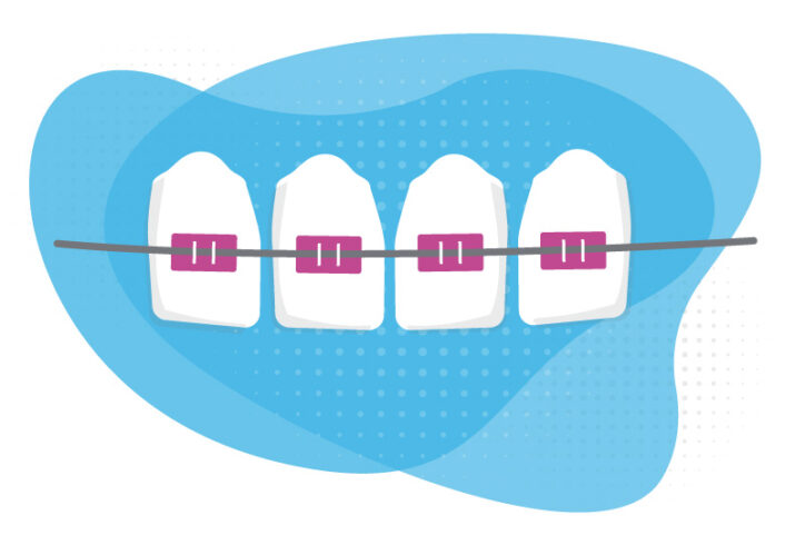 An illustration shows red braces running across four top teeth.