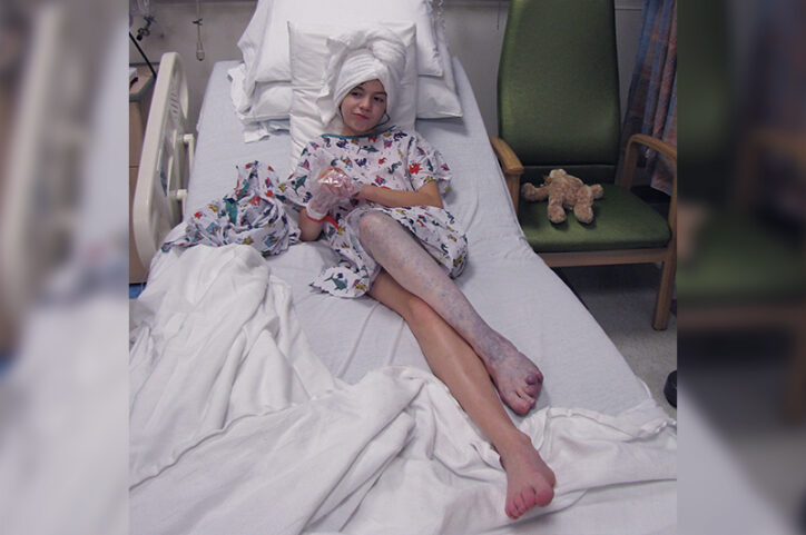 Katie Ladlie in a hospital bed, with a venous malformation in her leg.