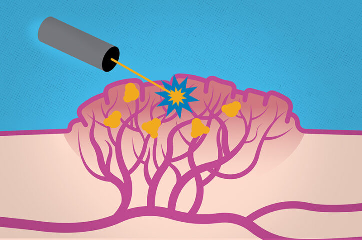 A cartoon of nanoparticles in a venous malformation being hit with a beam of light.