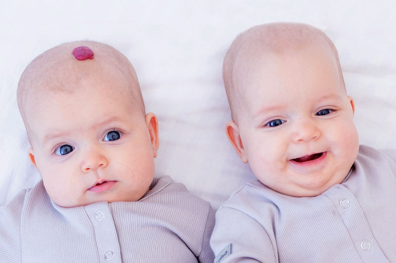 Two babies are side by side, dressed identical. The baby on the left has a red mark on their head, the other baby does not.