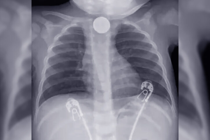 a radiograph showing the button battery lodged in Nathan's esophagus