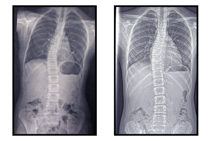 X-ray images show a 26 degree curve at diagnosis reduced to 19 degrees with consistent bracing in patient with scoliosis.