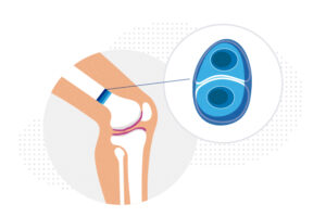 An illustration highlights the chondrocyte cell's place in a leg bone.
