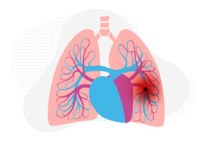 An illustration of the lungs points to pulmonary remodeling at the cellular level.