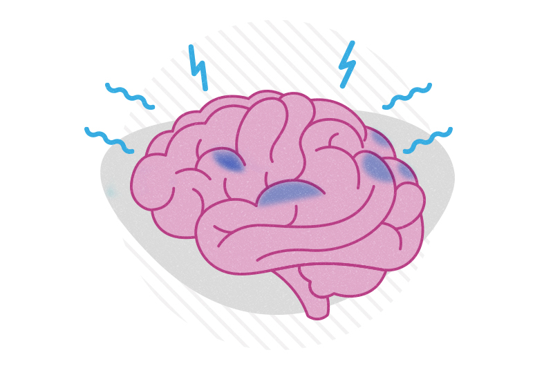 A brain with hotspots highlighted, with squiggles suggesting seizures.