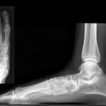 X-ray images of flexible flatfoot