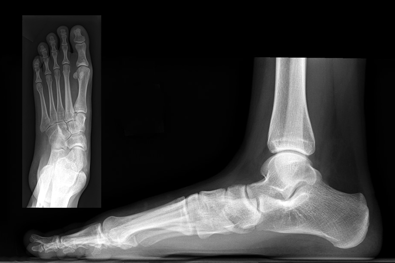 X-ray images of flexible flatfoot