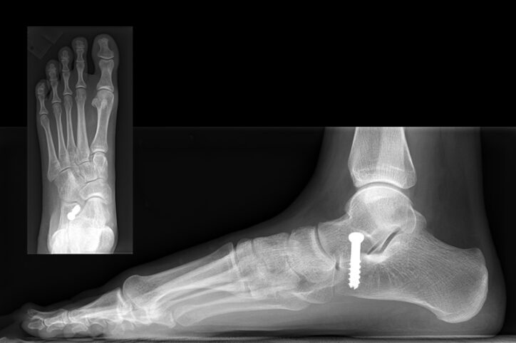 X-ray image of a foot with a SESA screw in place below the ankle.