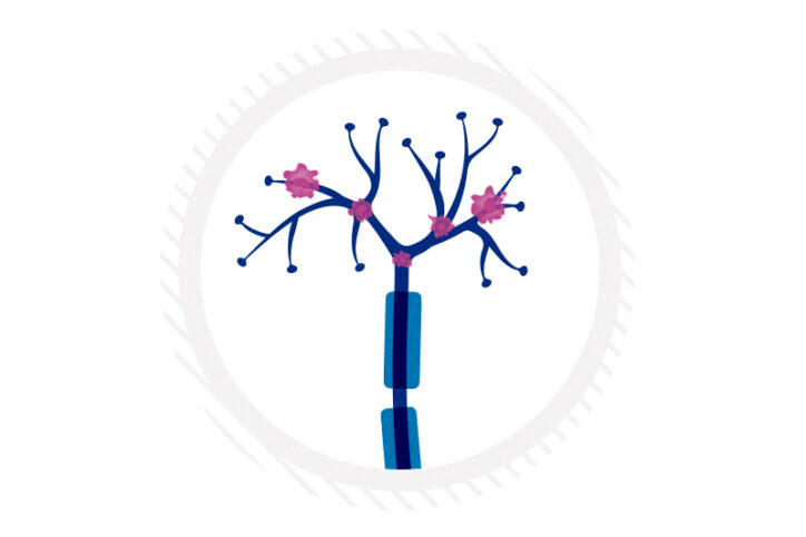 Drawing of a nerve ending with macrophages clustered at the axon tips.