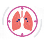 Lungs with macrophages in the airways, illustrating the concept of macrophage-based therapy for pulmonary hypertension.