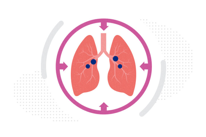 Lungs with macrophages in the airways, illustrating the concept of macrophage-based therapy for pulmonary hypertension.