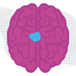 An illustration of a brain with an area marked to represent a tumor