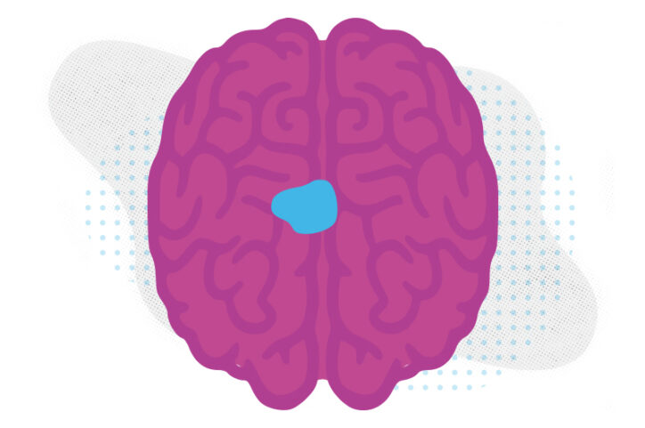 An illustration of a brain with an area marked to represent a tumor