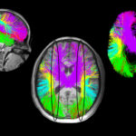 Three angles of a MRI showing white matter injury in a child.