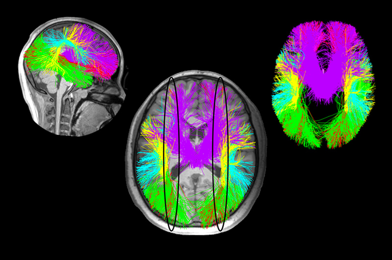 Three angles of a MRI showing white matter injury in a child.