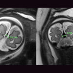 MRI images of the falcine sinus with diameters of .36 cm and .96 cm