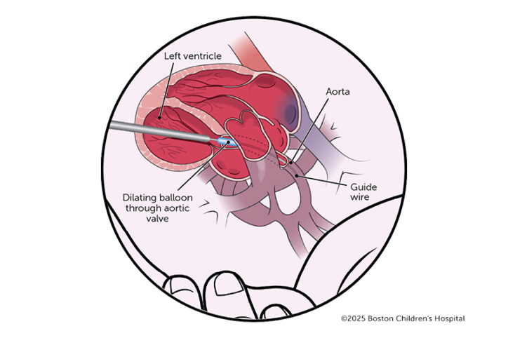 Drawing of a guide wire leading a dilating balloon through a left ventricle and aortic valve, and into the aorta.