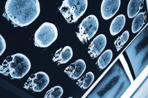 Multiple head MRI films arranged on a lighted wall.