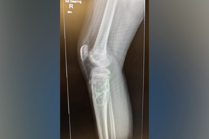 An x-ray of a leg in which a bone tumor in the main bone in the shin is almost as wide as the bone.