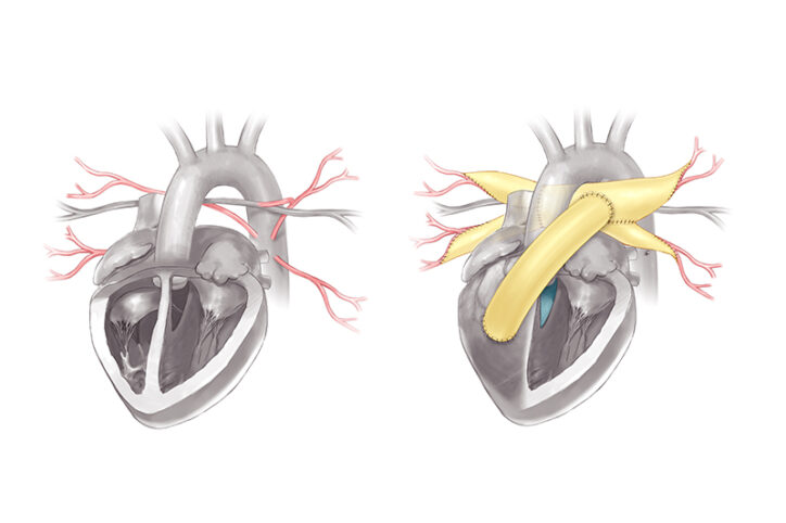 Side-by-side illustrated comparisons of a heart before and after MAPCAs surgery.