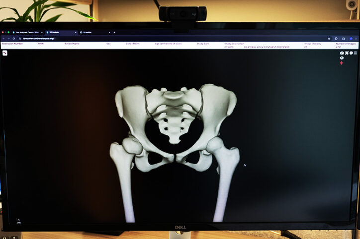 3D model of a hip displayed on a computer screen.
