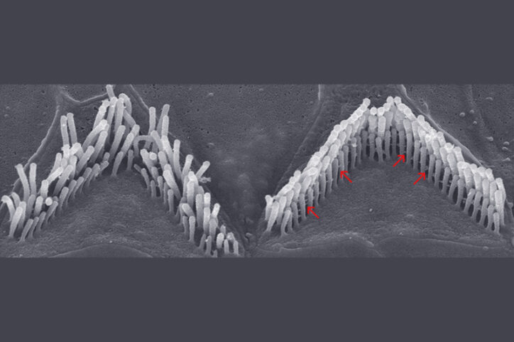 Inner ear hair cells shown under a microscope; healthy on the left and damaged, bent cells on the right.