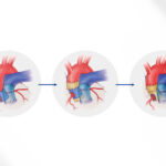 A depiction of a Ross procedure: a pulmonary valve is placed in the aortic root and prosthetic material is added for support.