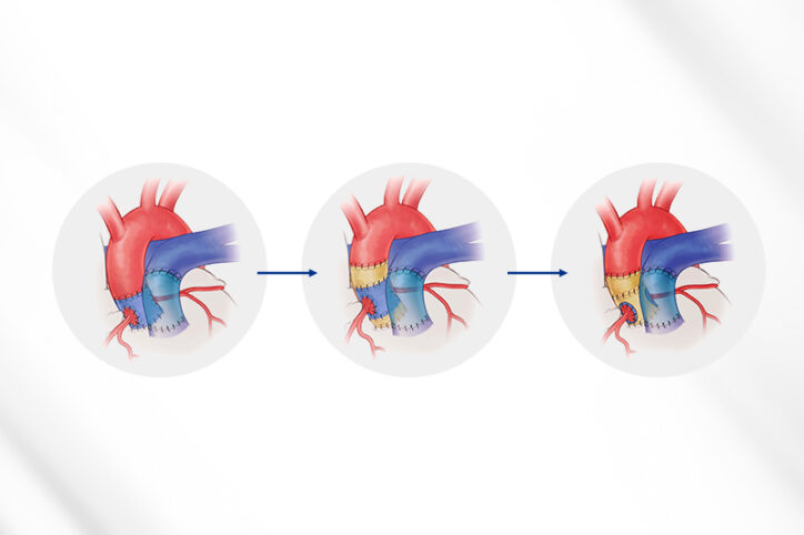 A depiction of a Ross procedure: a pulmonary valve is placed in the aortic root and prosthetic material is added for support.