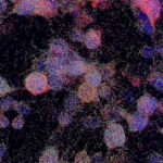 Blobs speckled tumor cells.