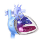 The right ventricle (RV) atop the left ventricle (LV) and near the aorta (AO), pulmonary artery (PO), and right atria (RA).