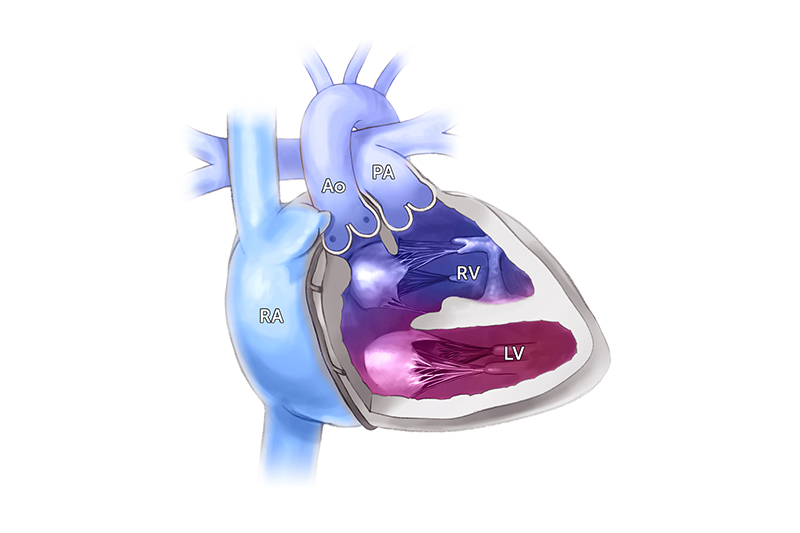 The right ventricle (RV) atop the left ventricle (LV) and near the aorta (AO), pulmonary artery (PO), and right atria (RA).